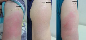 いわゆるモデルナアームについて 新着情報 横浜市青葉区の皮膚科 アレルギー科 美容皮膚科 形成外科